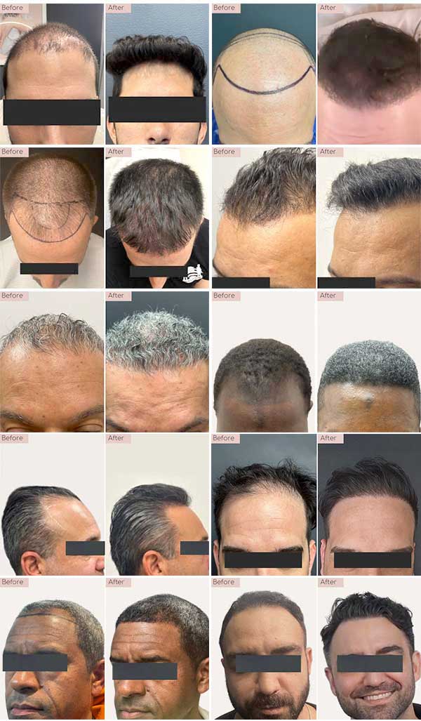 hair transplant before and afters